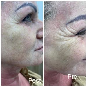 حقن البوتكس للوجه في رأس غارب